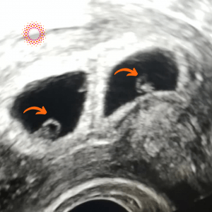 Το πρώτο υπερηχογράφημα κύησης